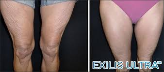 giảm béo đùi bằng công nghệ máy exilis dui exilis 1.jpg (7 KB)